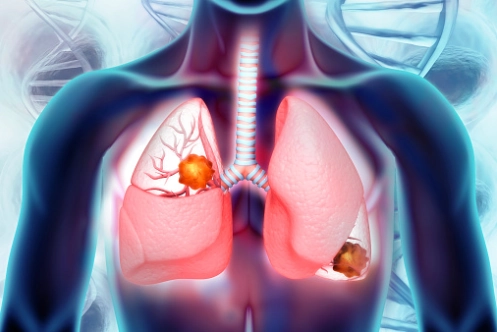 Ung thư phổi đa ổ nguyên phát đồng thời (Synchronous primary lung carcinoma - SPLC)