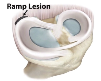 Tách sụn chêm-bao khớp/ Tổn thương Ramp (Ramp lesion) 