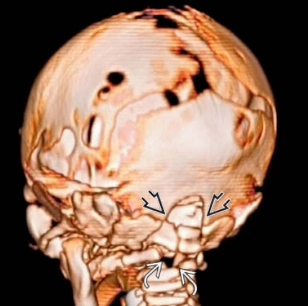 DỊ DẠNG CHIARI TYPE III (CHIARI 3)