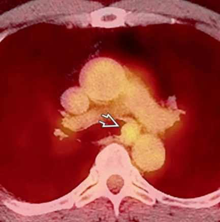 Ung thư biểu mô tuyến dạng nang khí phế quản (Adenoid Cystic Carcinoma of the Tracheobronchial)