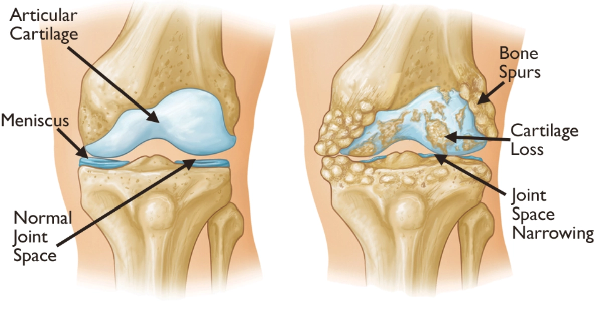 Thoái hóa khớp (Osteoarthritis)