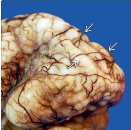 Đa hồi não nhỏ thai nhi (Polymicrogyria - PMG)