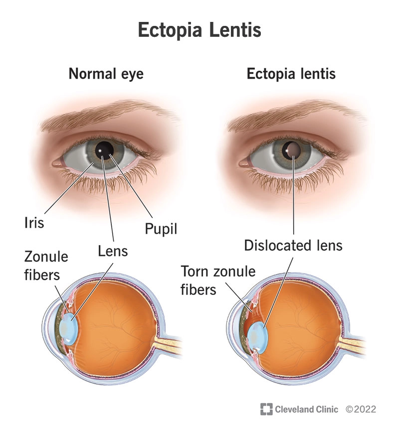 Lệch thủy tinh thể (Ectopia lentis)