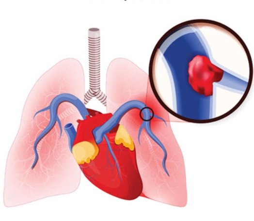 Thuyên tắc phổi nhiễm trùng (Septic pulmonary emboli)