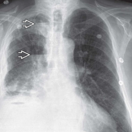 Thủng thực quản (chest) (Esophageal perforation)