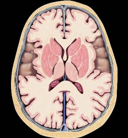 Nhiễm toan glutaric type 1 (Glutaric aciduria type 1)  