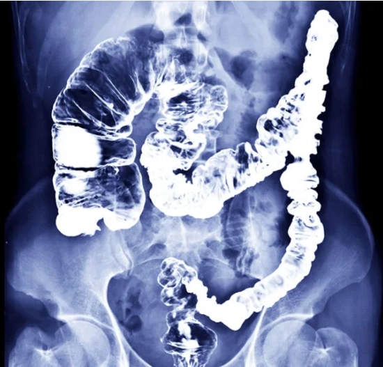 Viêm đại tràng do ứ phân (Stercoral colitis)