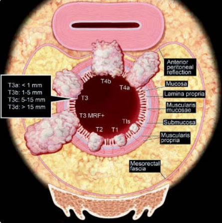 Ung thư trực tràng (Rectal cancer)