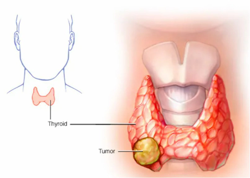 Ung thư tuyến giáp thể nhú (Papillary thyroid carcinoma)