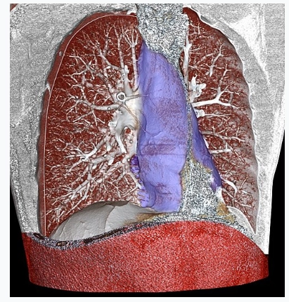 Viêm trung thất (Mediastinitis)