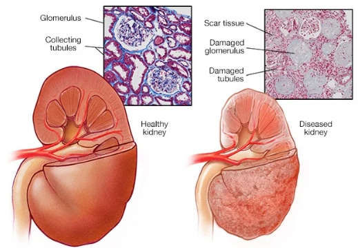 Bệnh thận mạn (Chronic Kidney Disease - CKD)