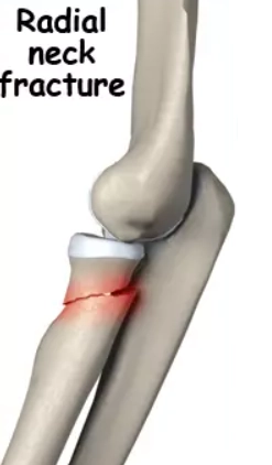 Gãy cổ xương quay (Radial neck fracture)