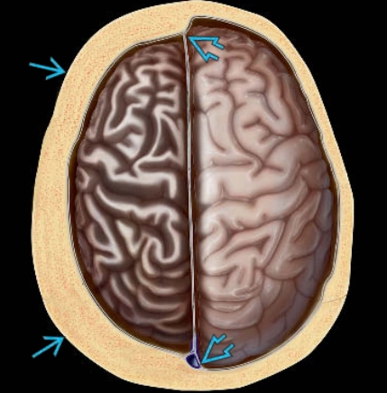 Teo nửa bán cầu đại não (Cerebral hemiatrophy)/Hội chứng Dyke-Davidoff-Masson (DDMS)