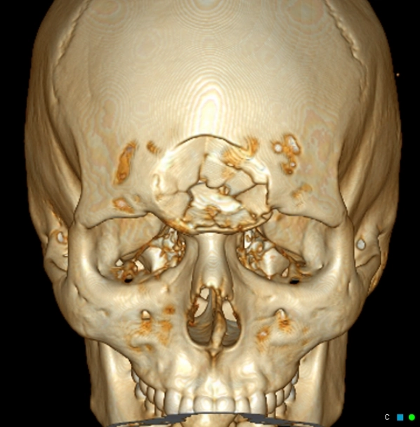 Vỡ lún xương sọ (Depressed Skull Fracture)