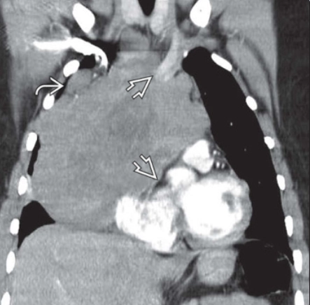 U Tinh (Seminoma) trung thất (Mediastinal Seminoma)