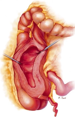Viêm manh tràng giảm bạch cầu (Neutropenic Colitis [Typhlitis])