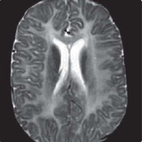 Bệnh lý chất trắng (White matter disease)
