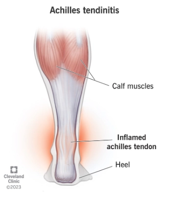 Viêm gân Achilles (Achilles tendinopathy)