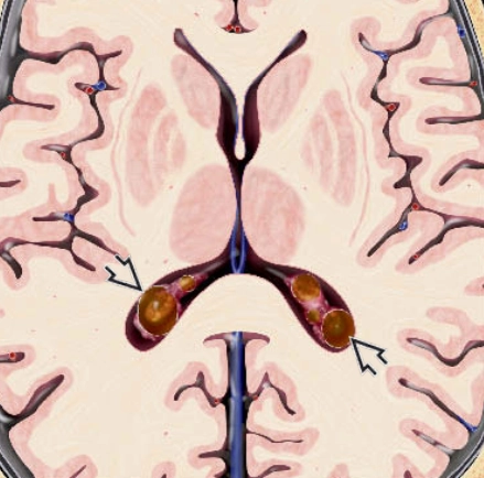 Nang đám rối mạch mạc (Choroid plexus cyst - CPC)/ U hạt vàng đám rối màng mạch (Choroid plexus xanthogranulomata) 