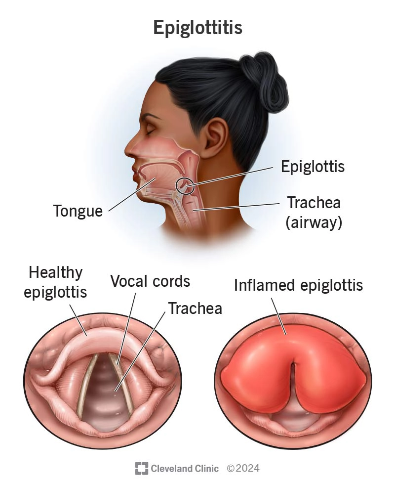Viêm trên thanh môn (Epiglottitis)