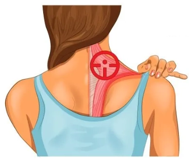 Viêm cơ cốt hóa (Myositis ossificans)