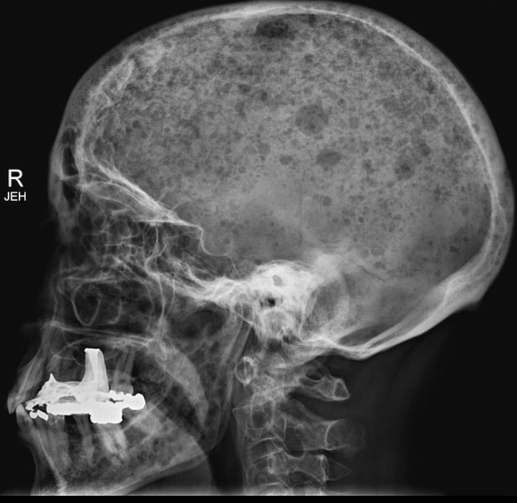 U đa tủy ở sọ não (Myeloma)