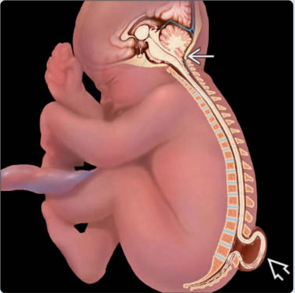 Dị dạng Chiari 2 thai nhi (Chiari 2 malformation)