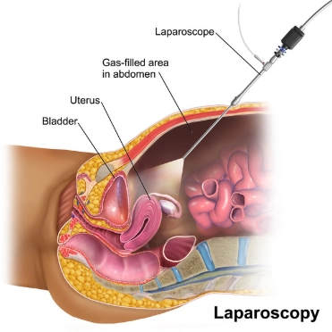 Khí tự do trong ổ bụng sau mổ (Postoperative Free Intraperitoneal Gas)