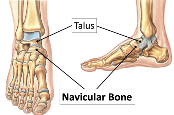 Hoại tử vô mạch xương ghe ở người lớn (Müller-Weiss syndrome)