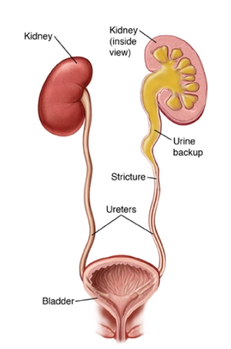 Hẹp niệu quản (Ureteral stricture)