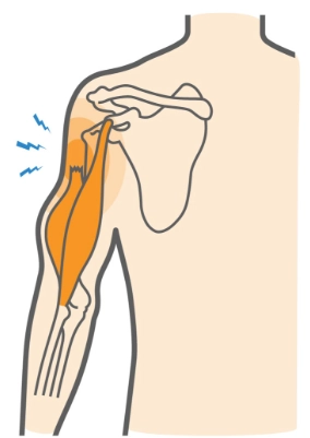 Rách gân cơ nhị đầu đoạn trong khớp (Biceps Tendon Tear, Intraarticular)