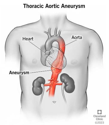 Phình động mạch chủ ngực (Thoracic aortic aneurysm)