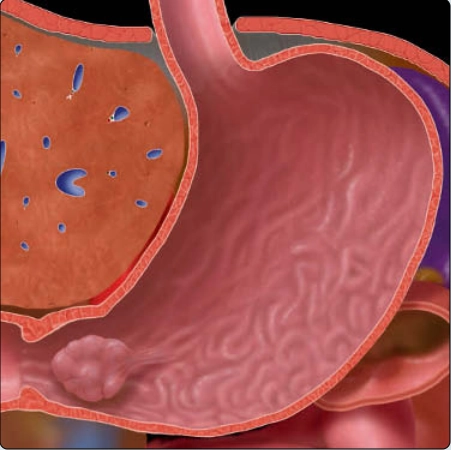 Polyp dạ dày (Gastric Polyps)