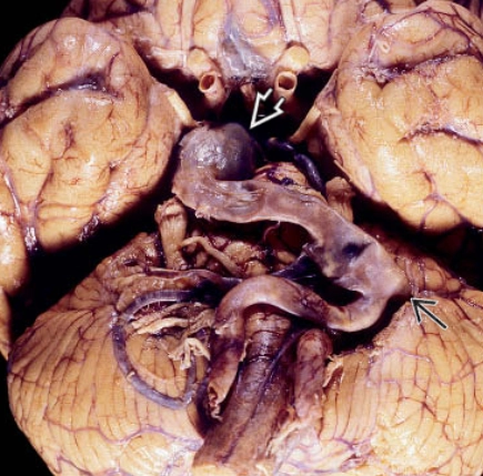 Phình mạch nội sọ dạng hình thoi (Fusiform Intracranial Aneurysm)