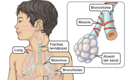 Nhiễm trùng đường hô hấp do virus (Viral respiratory tract infection)