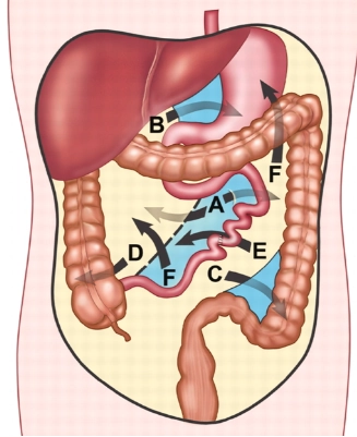 Thoát vị Nội (Internal Hernia)