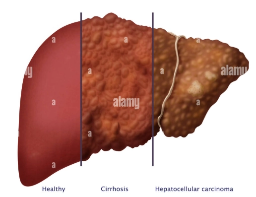 Chẩn đoán phân biệt các nốt gan xơ  (Cirrhotic liver nodules - differential)