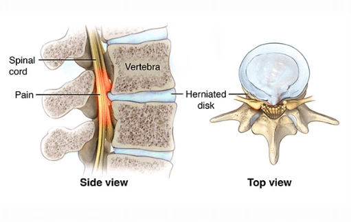Tủy sống bị chèn ép (Compressive myelopathy)