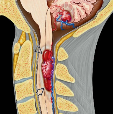 Von Hippel-Lindau (vHL)
