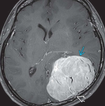 U tế bào sợi đơn độc màng cứng (Solitary Fibrous Tumors - SFTs of the Dura)/U tế bào quanh mạch (Hemangiopericytoma - HPC)