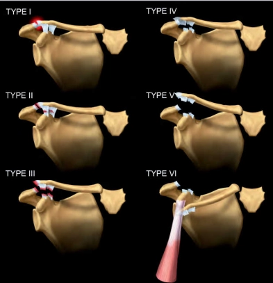 Trật khớp cùng - đòn (Acromioclavicular joint injuries)