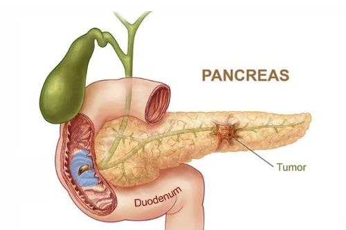U nội tiết tụy (Pancreatic Neuroendocrine Tumors - pNET)