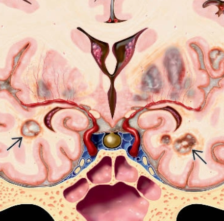 Lao hệ thần kinh trung ương (Central nervous system tuberculosis - CNS-TB)
