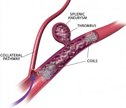 Phình động mạch lách (Splenic Artery Aneurysm - SAA)