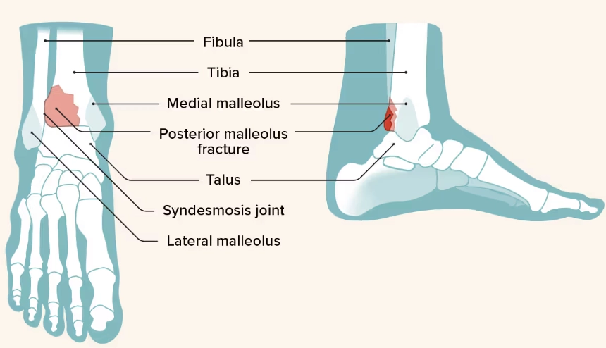 Gãy mắt cá sau (Posterior malleolus fracture)