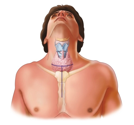 Bướu giáp trung thất (Mediastinal Goiter)/Bướu giáp sau xương ức (Retrosternal/Substernal goiter)