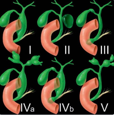 Nang ống mật chủ (Choledochal Cyst)