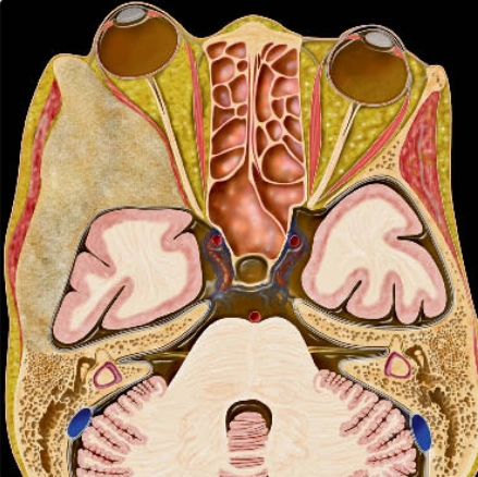 Loạn sản xơ sọ mặt (CFD - Craniofacial Fibrous Dysplasia)