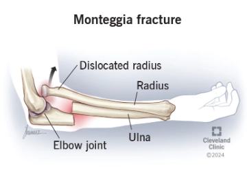 Gãy Monteggia ( gãy trật khớp khủy)