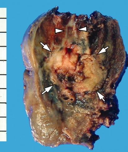 Actinomycosis phổi (Thoracic Actinomycosis) 